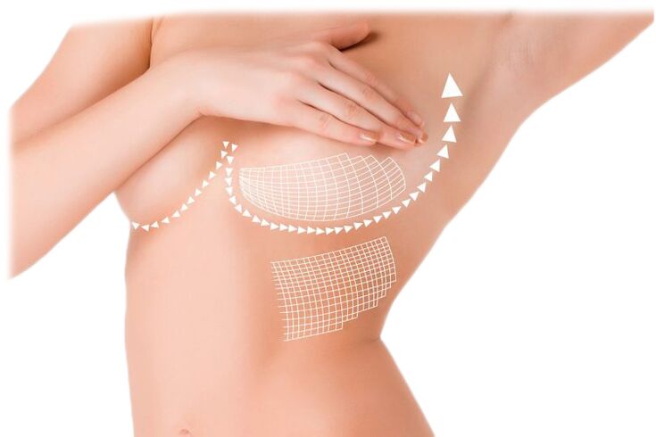 The effect of Mammax capsule on breast augmentation
