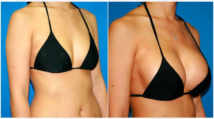 Plastic surgery breast augmentation before and after
