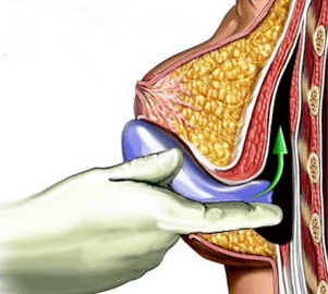 Breast implant surgery