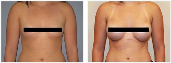 Breast before and after surgery