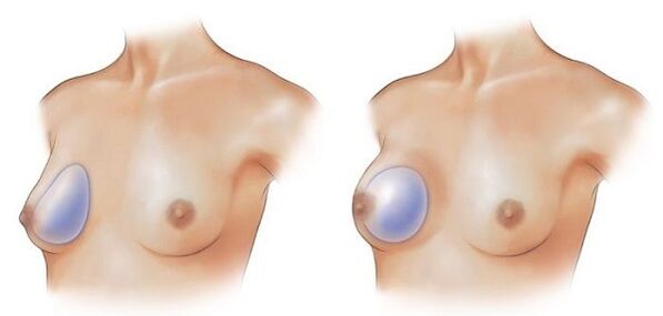 Drop and round implants for breast augmentation