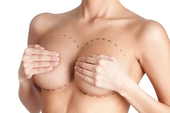 Signs of breast augmentation surgery